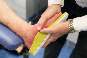 myPedorthist Exacta3D fitting orthotics for Charcot's Foot patient