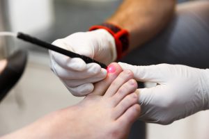 PinPointe FootLaser treatment for onychomycosis (fungal nails)