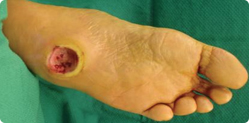 Diabetic Foot Ulcer in Charcot's Foot Patient